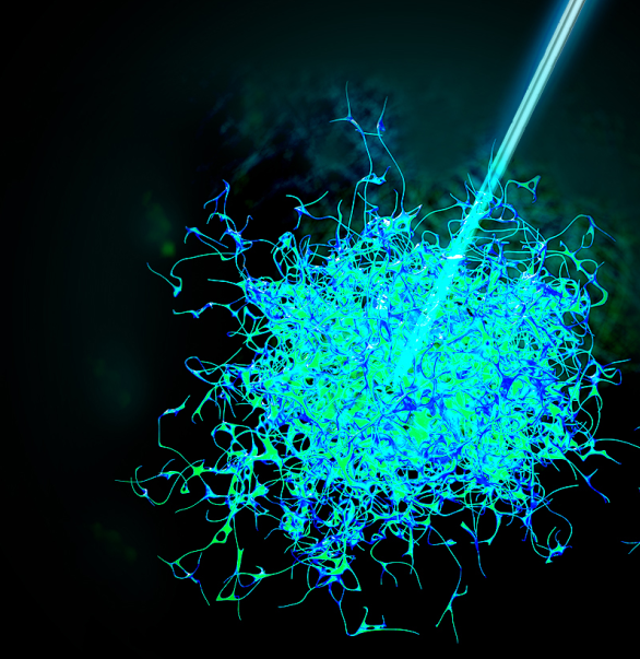 今天，我們把腫瘤的內(nèi)部「融穿」了